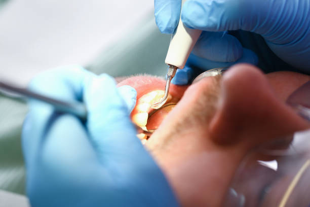 Best Dental Abscess Treatment in Baldwinville, MA